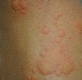 鯖 アレルギー 蕁麻疹 写真